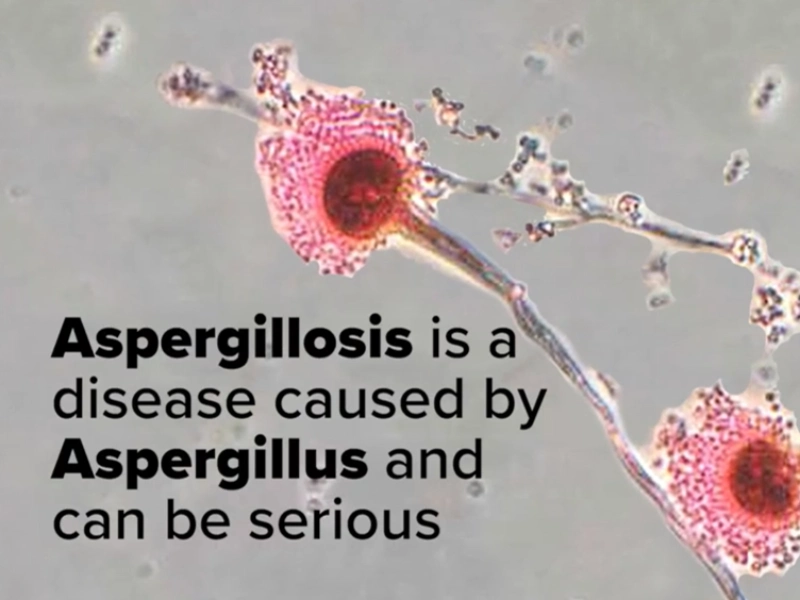 Aspergillosis serious disease Gainesville
